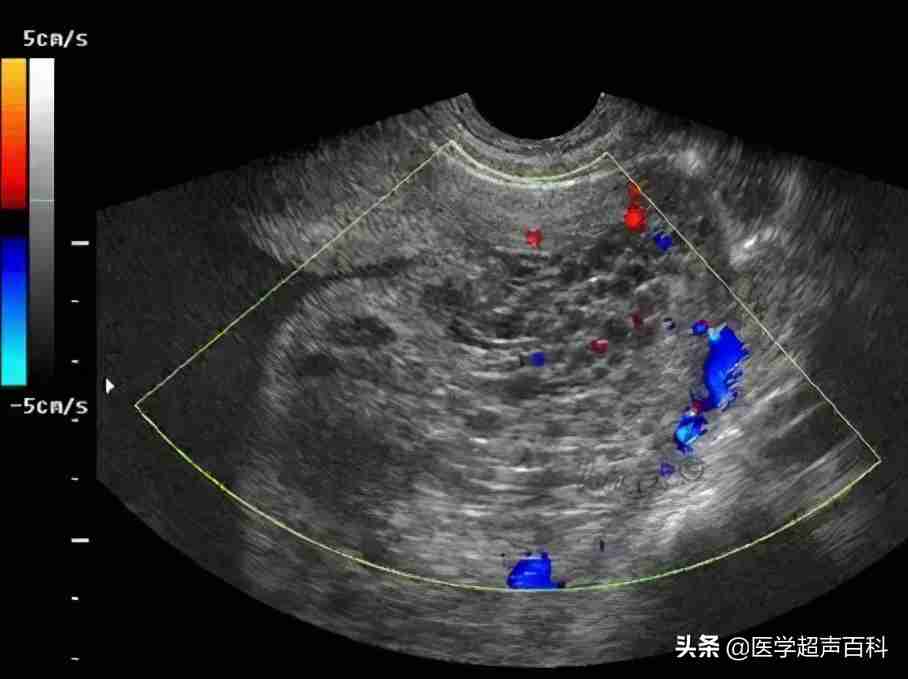 葡萄胎是什么(胎儿都成型了还是葡萄胎)