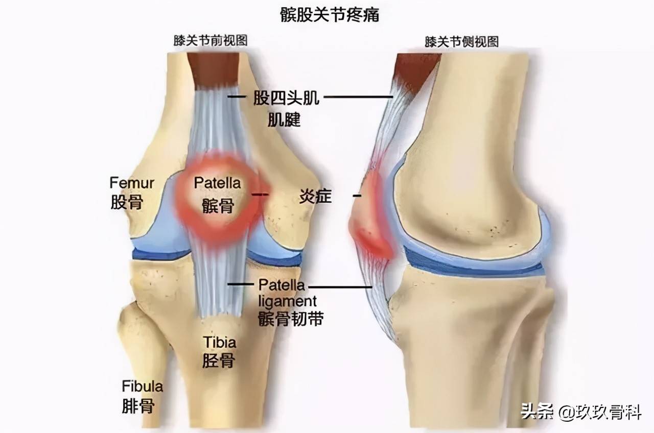 髌骨骨折多久可以下地(左髌骨骨折多久能好)