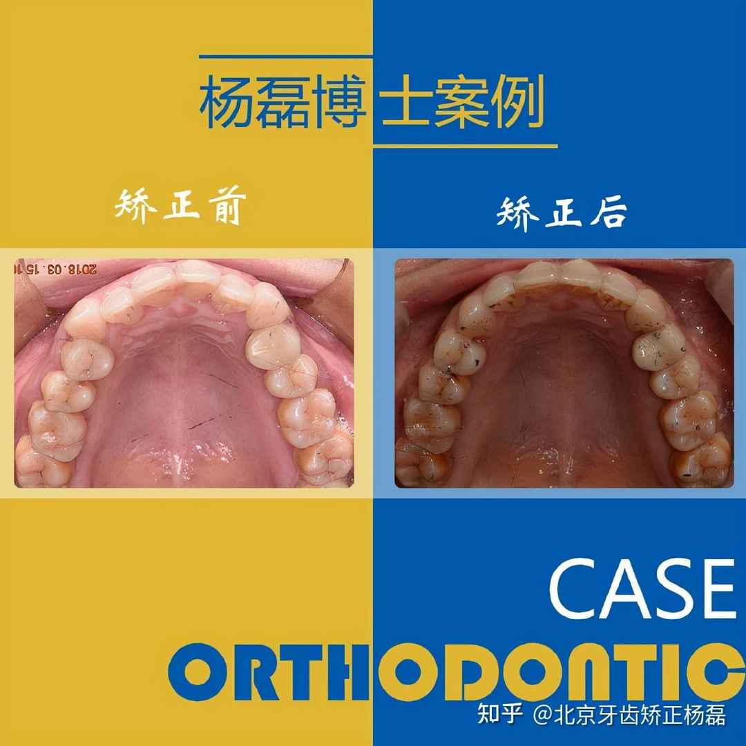 牙齿不齐怎么矫正(下牙不齐有点拥挤怎么矫正)